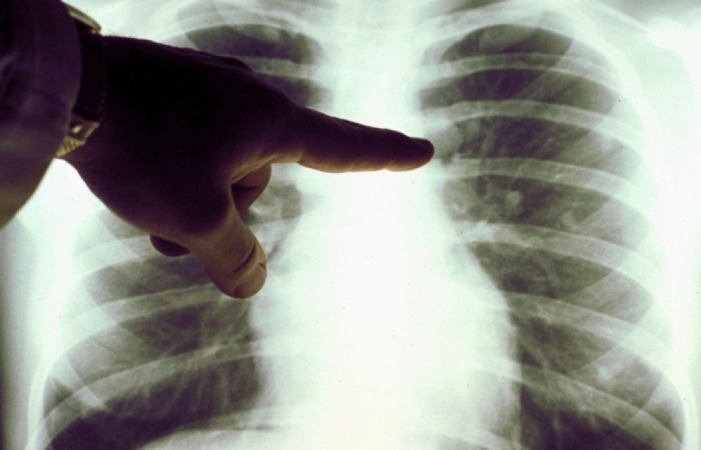 В Хакасии бесплатное обследование жителей на туберкулез помогло выявить больных