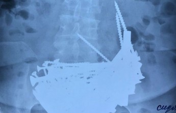 В Бурятии пенсионерка 14 лет лечила анемию гвоздями и шурупами