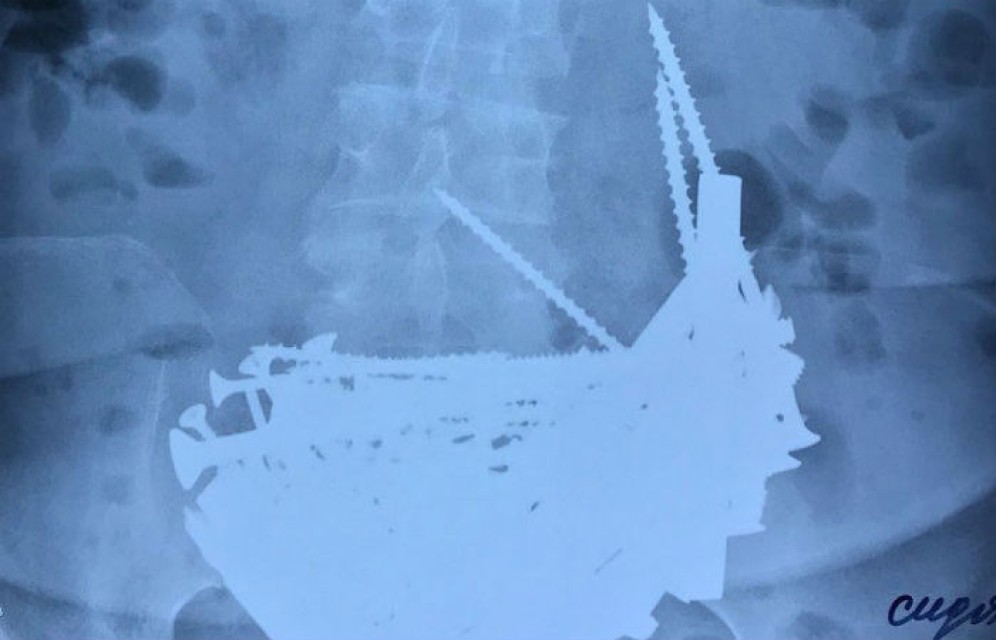 В Бурятии пенсионерка 14 лет лечила анемию гвоздями и шурупами