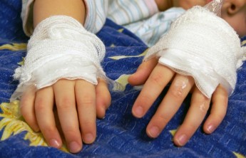 В Хакасии маленькие дети получили дома ожоги