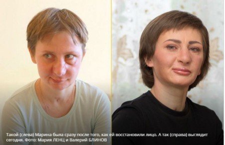 Пострадавшая в схватке с медведем жительница Хакасии получила новое лицо