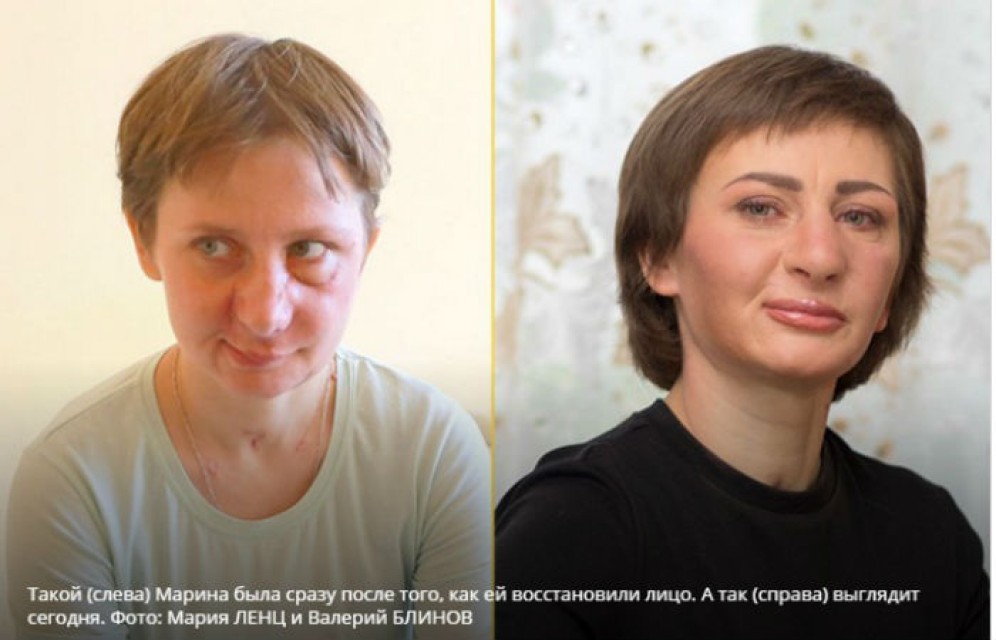 Пострадавшая в схватке с медведем жительница Хакасии получила новое лицо